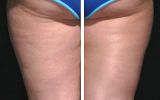 Dieta: Ciccia e Cellulite Addio 2